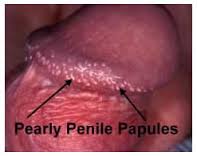 Penile papules tiny What Are